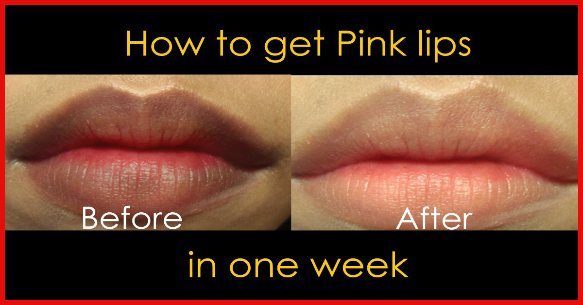 10 Proven Ways To Get Rid Of Dark Lips Naturally Worked For 99 People Who Tried