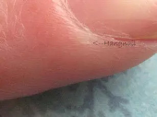 Cure Hangnails