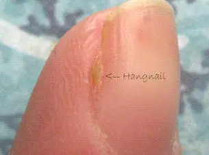 Hangnails Defeciency