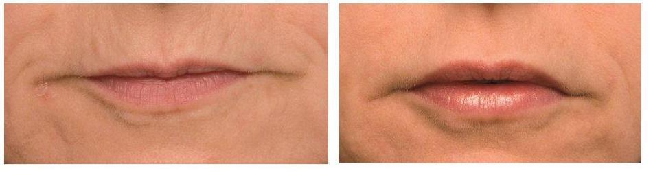 Laser Lip Rejuvenation