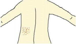 common causes bacne