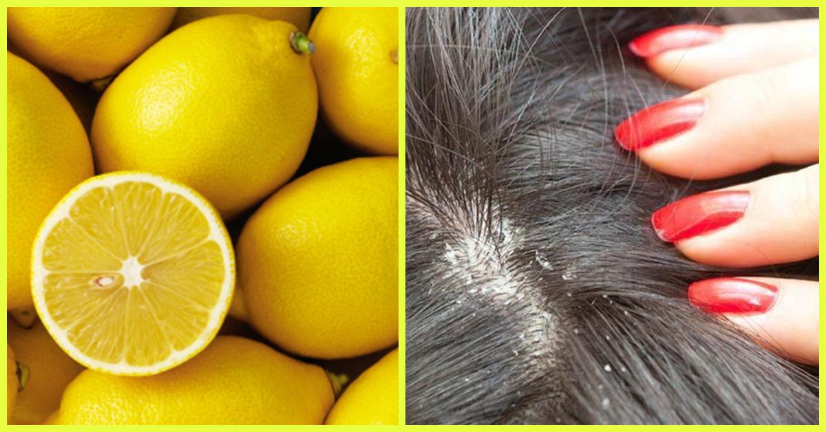 Image result for lemon for dandruff