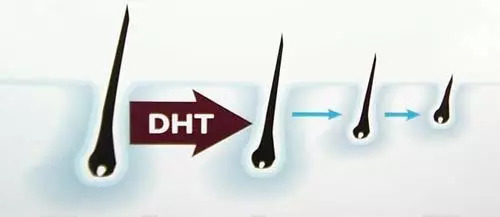 Laser Therapy for hair