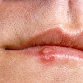 How To Get Rid Of Cold Sores?