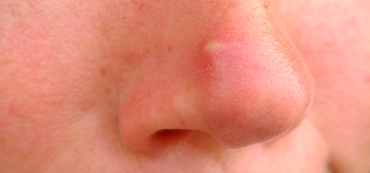 Acne Cysts On Face | www.imgkid.com - The Image Kid Has It!