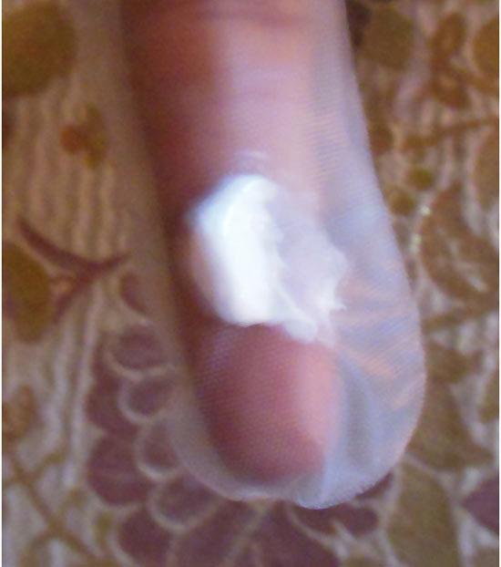 pimple toothpaste remedy pimple toothpaste remedy
