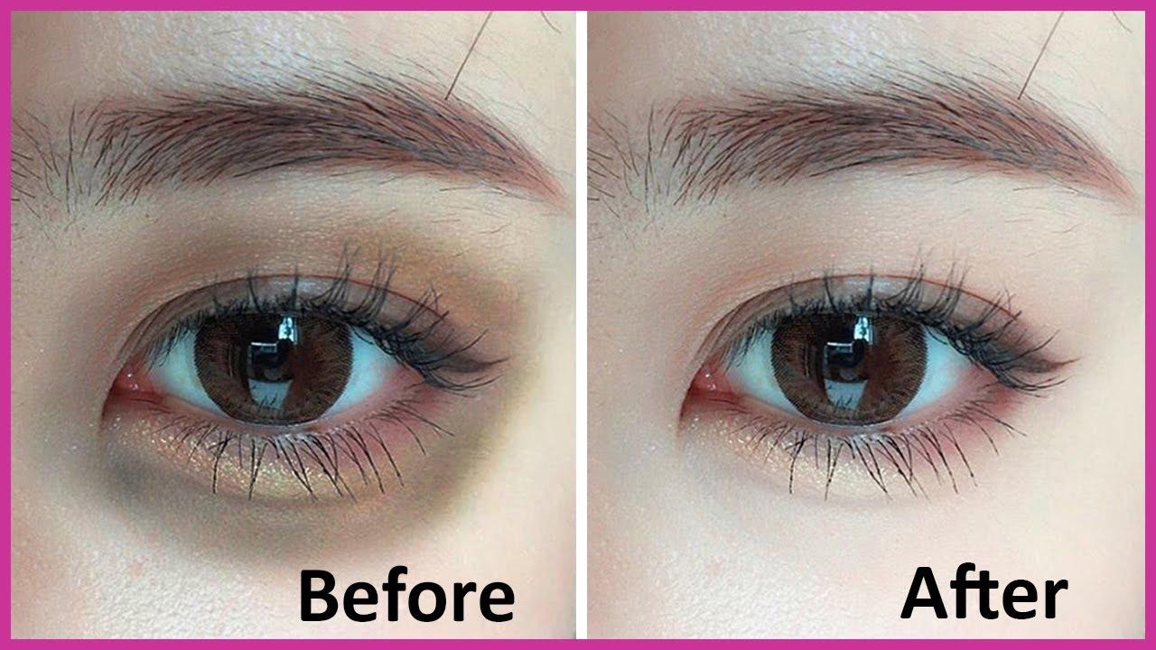 27 Best Home Remedies To Remove Dark Circles Under Eyes Permanently