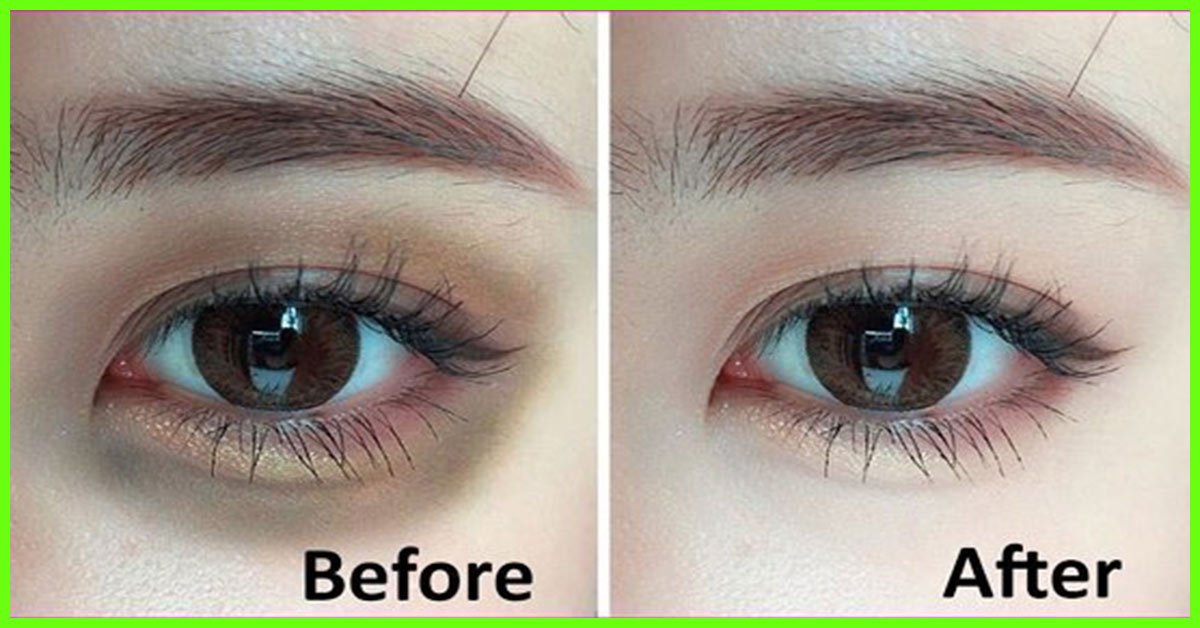 27 Best Home Remedies To Remove Dark Circles Under Eyes Permanently