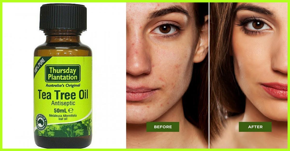 Image result for Tea tree oil to reduce pimples