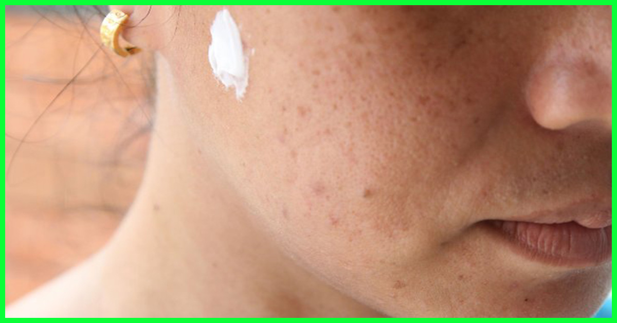 How To Use Toothpaste To Fight Pimples 2 - 6 effective ways to cure acne with toothpaste