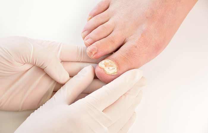 13. Treats Nail Fungus