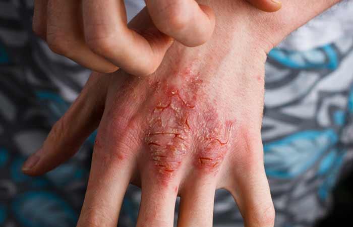 9. Treats Eczema And Psoriasis