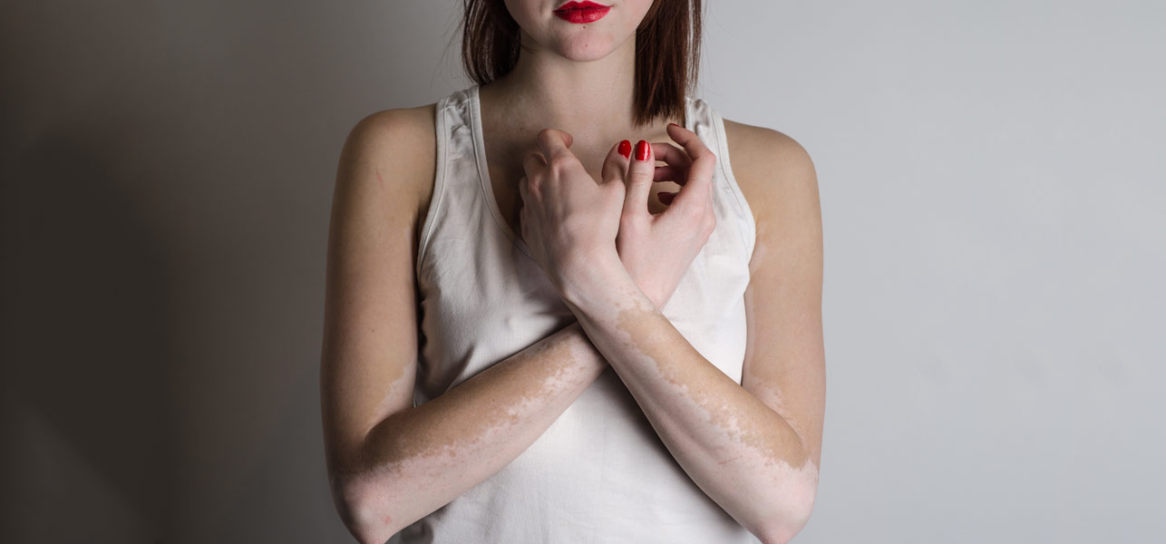 Vitiligo Pictures Of White Skin Redhead 71
