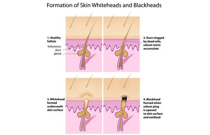 how to get rid of masturabation pimples pdf