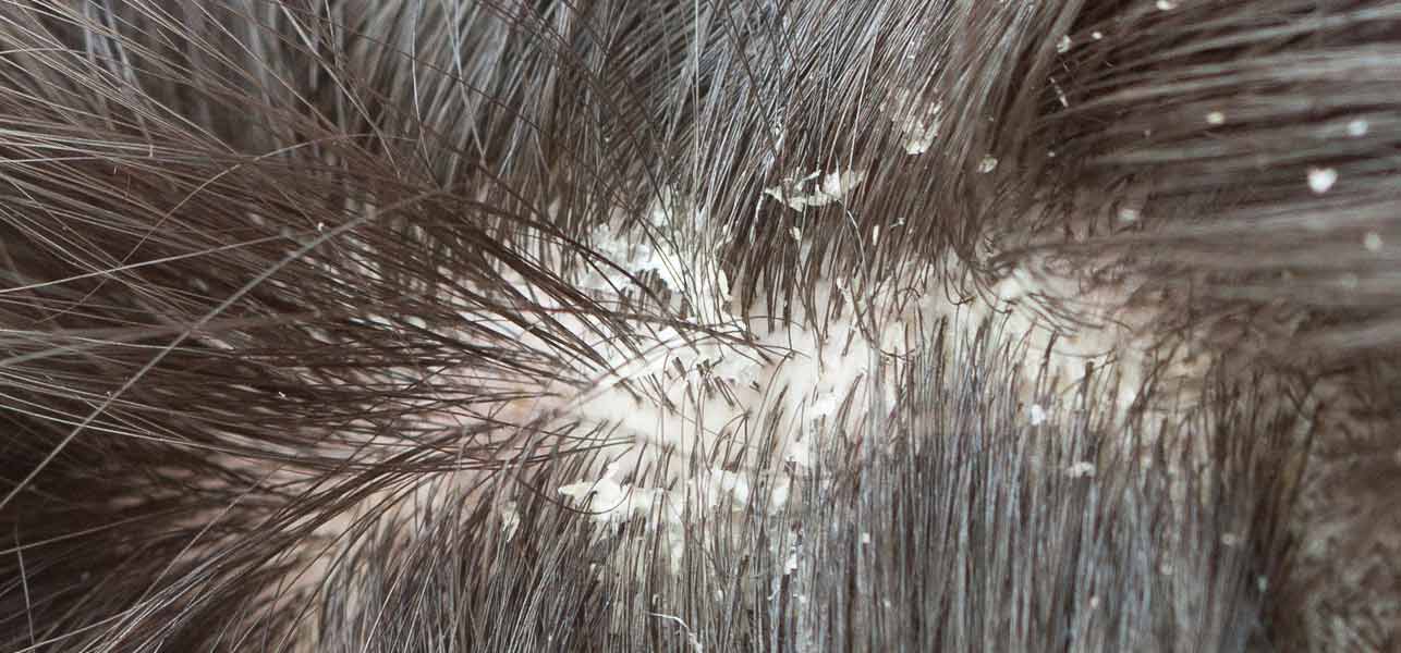 Dandruff in Adults: Condition, Treatments, and Pictures ...