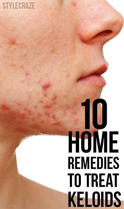 Top 12 Effective Home Remedies To Treat Keloids 3835