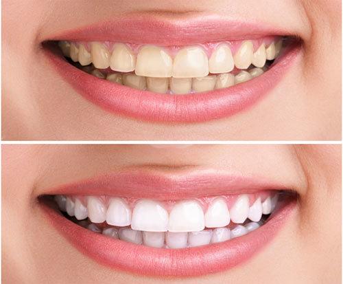 home remedies for yellow teeth