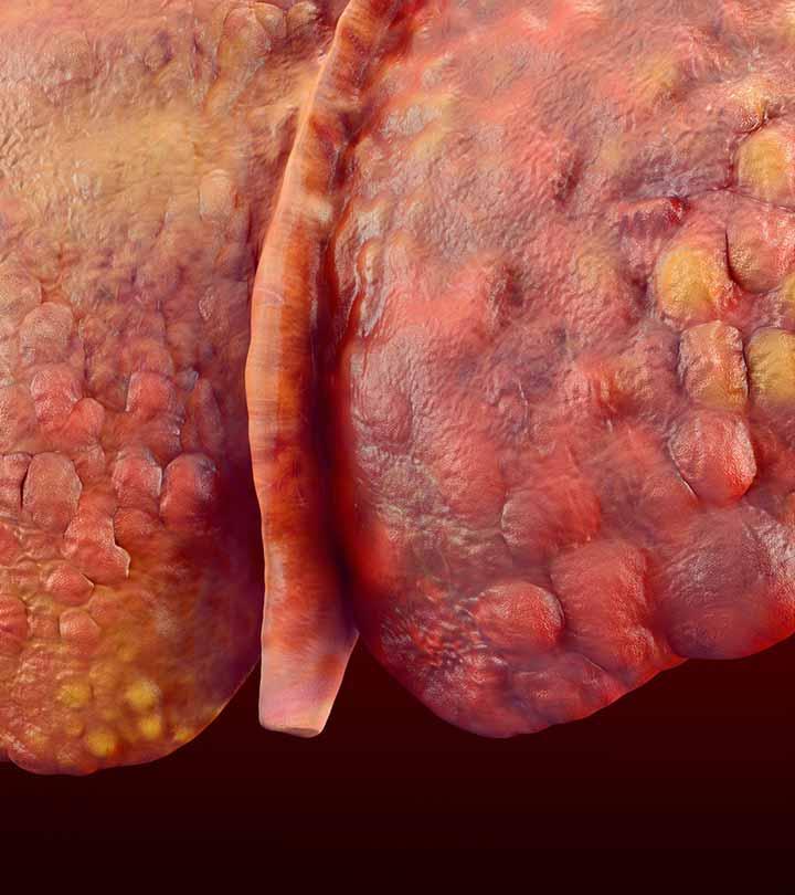 11 Effective Home Remedies For Cirrhosis Of Liver