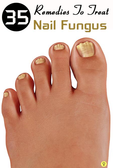 Toe Nail Fungus Treatment Designs 2017 Cute Gel Acrylic Taking Technicians At Their Word Most Of The Nail Disorders They See Are Fungal Infections Use Term Fungus To Describe Varying