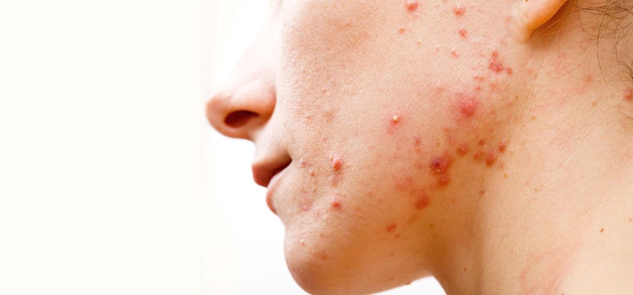 Rash 101: The Most Common Types of Skin Rashes