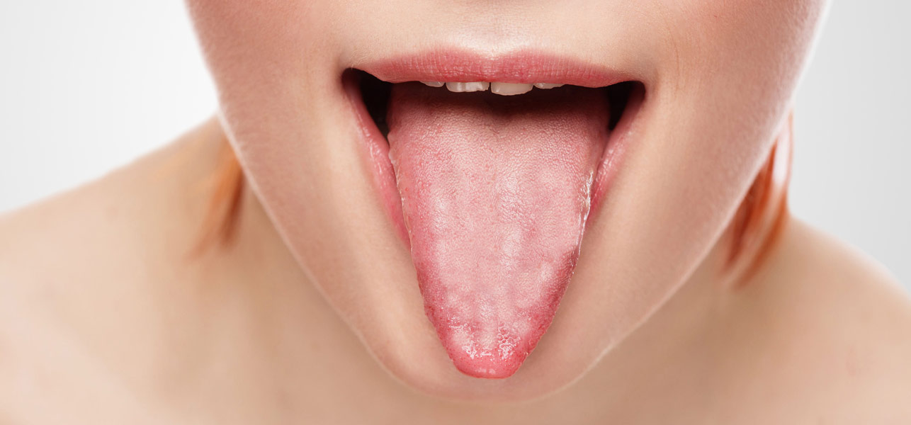 Cure For Hairy Tongue 47