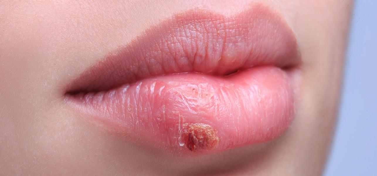 How long does it take fever blisters to go away?