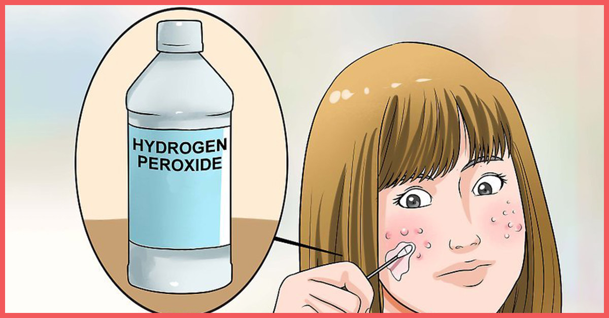 7 Simple Ways To Use Hydrogen Peroxide To Treat Acne