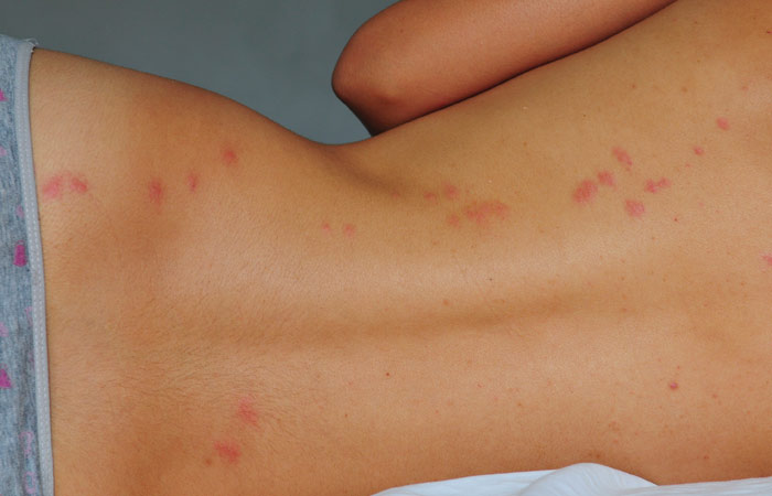 Signs Of Bed Bugs