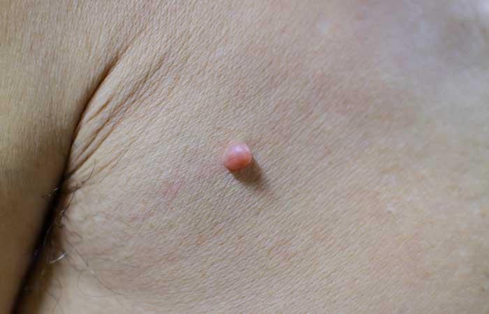 2. To Kill A Skin Tag