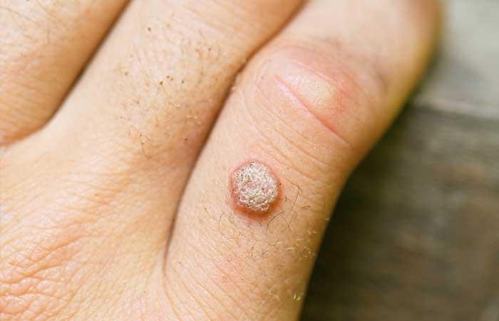 3. One Hundred Days of Warts No More!