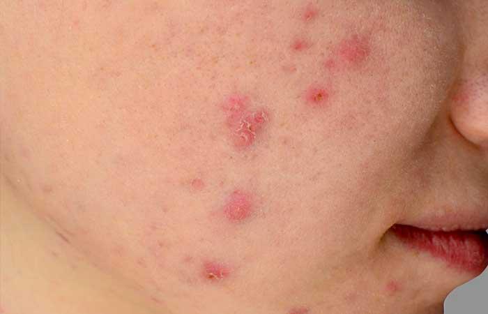 5. Solve The Curious Case of Clogged Pores