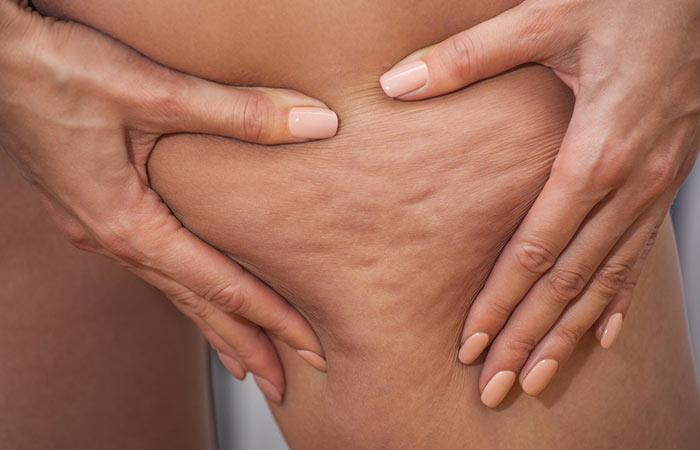 9. All The Bumps And Lumps That Appear On Your Skin Are Caused By Cellulite