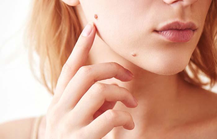 4. Sudden Appearance Of Moles