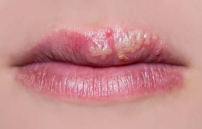 7. Cold Sores