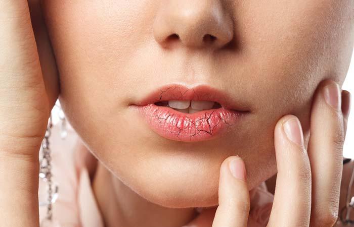 8. Chapped Lips