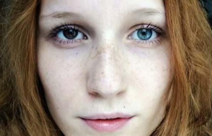 3. Do You have Heterochromia