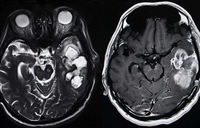 Brain Tumor Looks Like