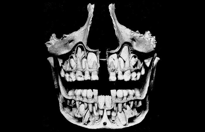 This Is What A Brain Tumor Looks Like