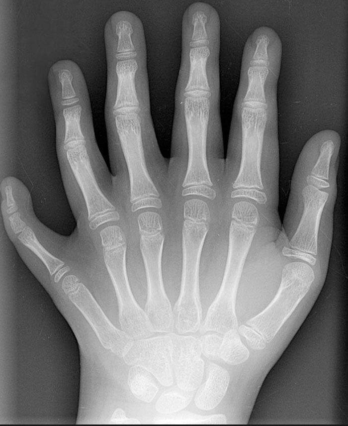 X-Ray Of A Hand With Six Fingers