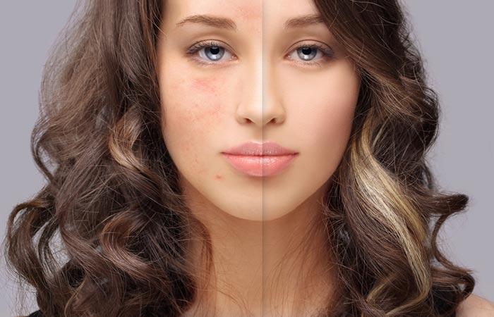 Medical Treatments That Help Get Rid Of Pimple Marks