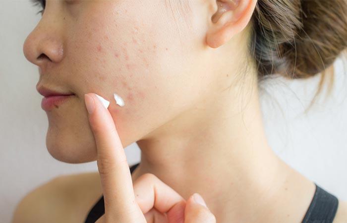 Salicylic Acid
