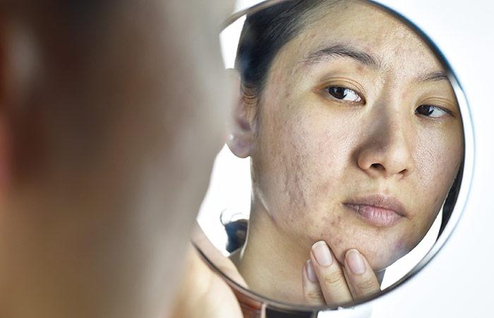Best Essential Oils For Scar Healing