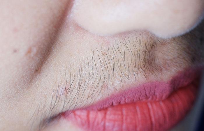 Unwanted Hair Growth
