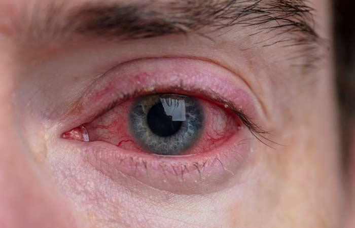 Sunflower oil benefits for cataract