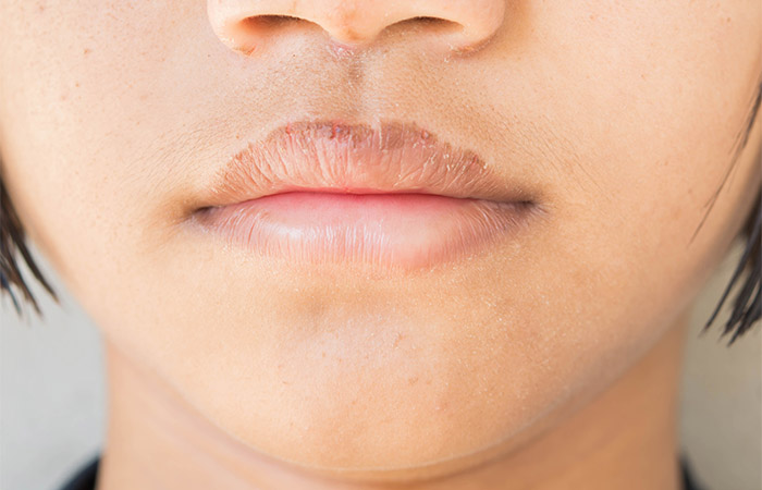 Close up of chapped lips that need a lot of care