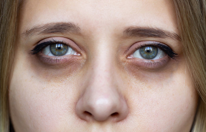 A woman with dark circles under her eyes