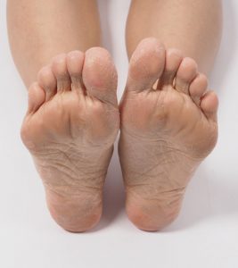 Dead Skin Under Feet: Causes, Symptom...
