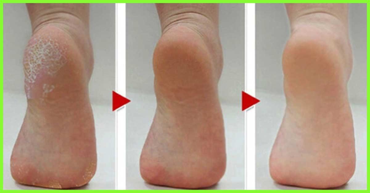 easiest way to remove dead skin from feet