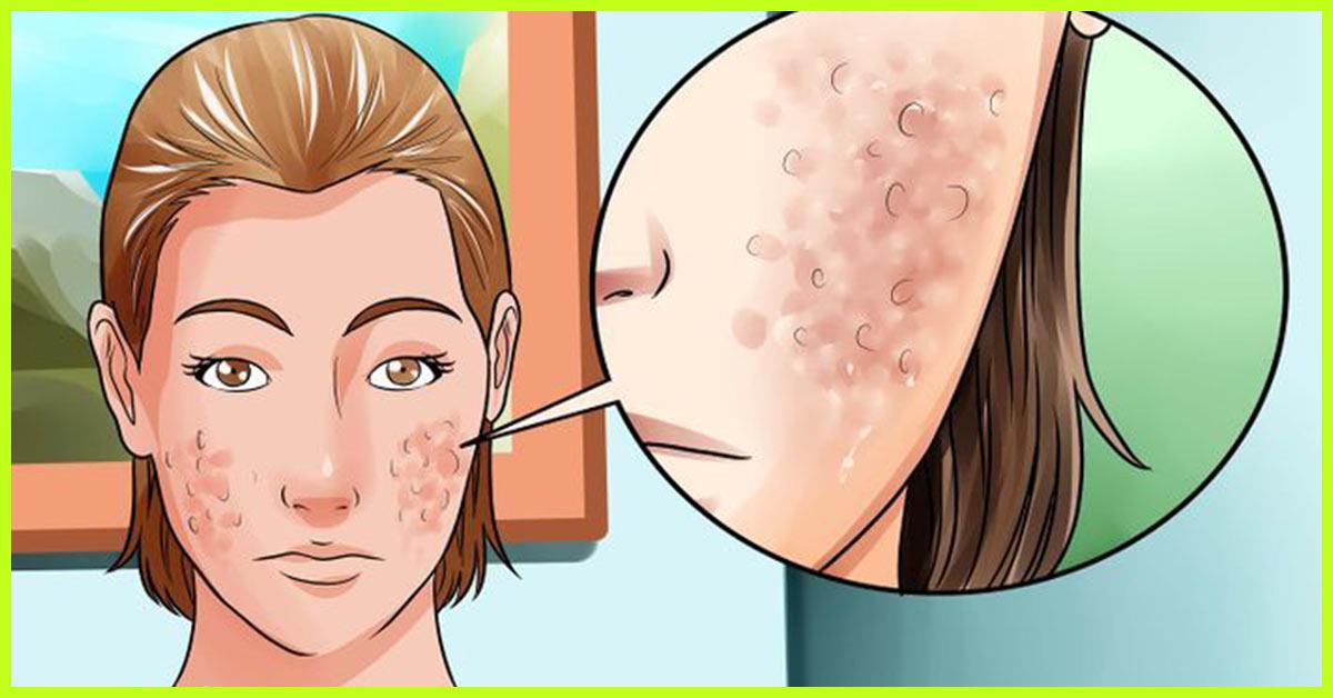 A Way To Getrid Of Zits  Acne Scars Speedy Youtube