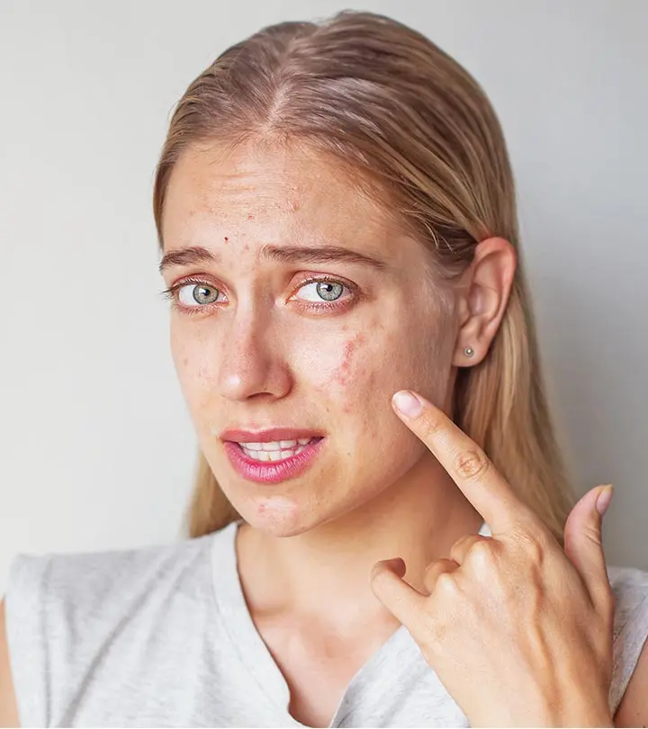 Girl with acne scars